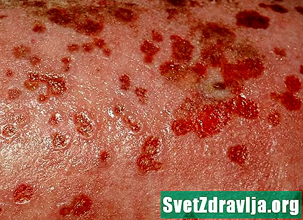 Mikä on Eczema Herpeticum ja miten sitä hoidetaan? - Terveys