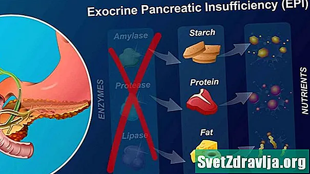 Che cos'è l'insufficienza pancreatica esocrina? Cosa hai bisogno di sapere - Salute
