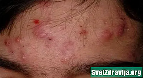 Wat is nodulaire acne en hoe wordt het behandeld?