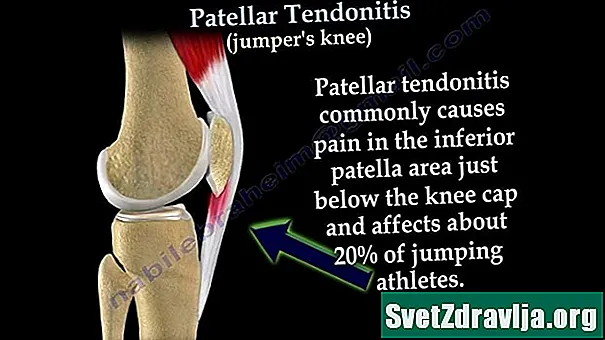Vad är patellar tendonitis (Jumper's Knee)? - Hälsa