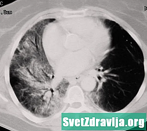 Qu'est-ce que la pneumonite par radiation et comment est-elle traitée? - Santé