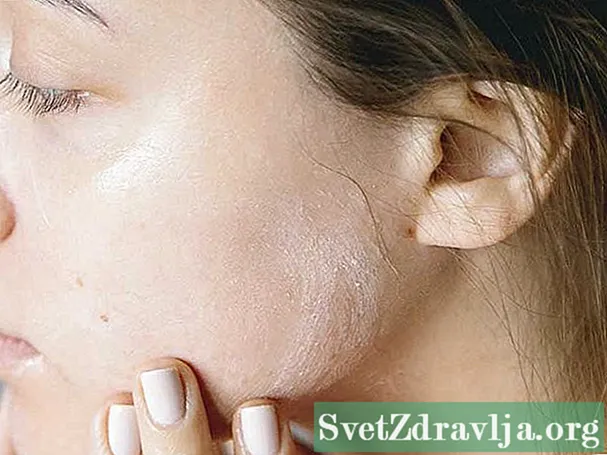 Iyini iRed Skin Syndrome (RSS), futhi Iphathwa Kanjani?