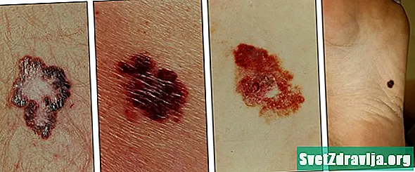 Ce este cancerul de piele?