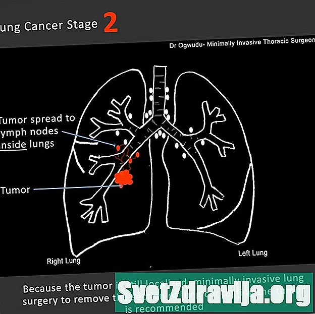 Hva er lungekreft i trinn 2?