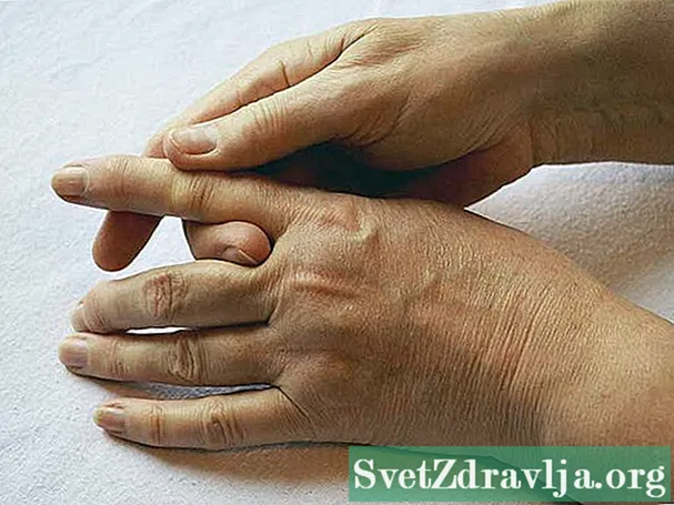 Kaj pričakovati od sprožilne kirurgije prstov - Wellness