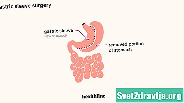 Ano ang Malalaman Tungkol sa Gastric Sleeve weight Loss Surgery