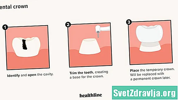 Čo potrebujete vedieť o zubných korunkách vyrobených zo zirkónu - Zdravie