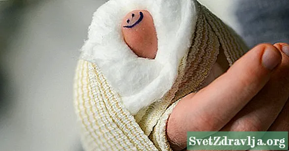 Čo by ste mali vedieť o identifikácii a liečbe zlomeného palca - Wellness