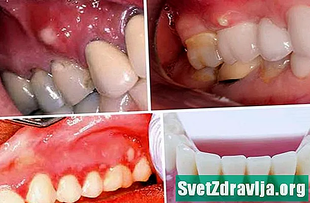 Pika të bardha në mishrat e dhëmbëve - Shëndetësor