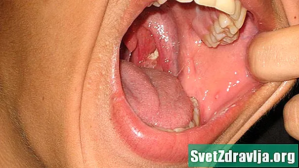 Perché ho buchi nelle mie tonsille?