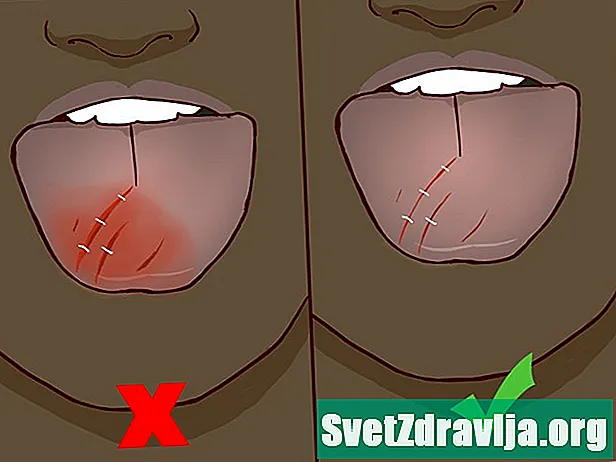 Zakaj nastane krvavitev iz jezika?