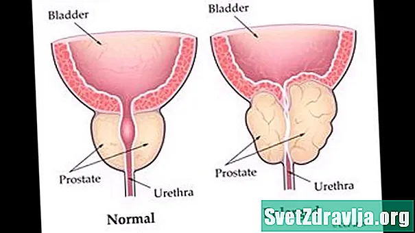 Adakah Kanser Prostat Akan Mempengaruhi Kehidupan Seks Anda?