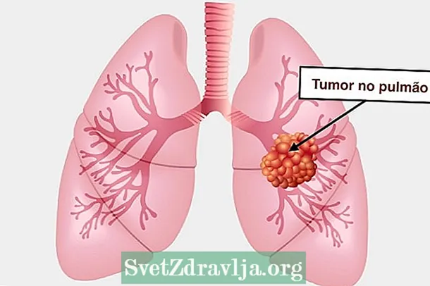10 Symptome, die Lungenkrebs sein können
