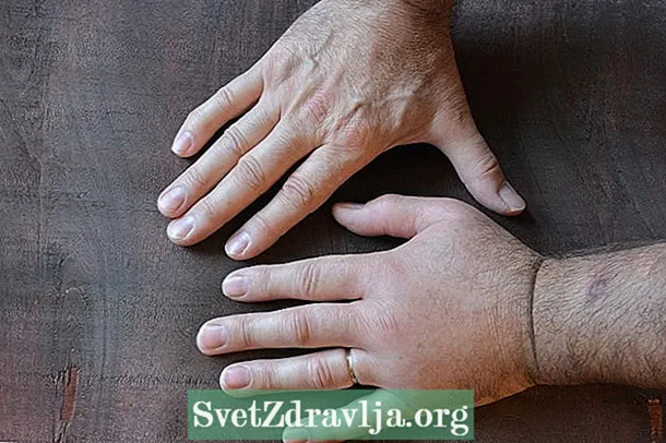 12 cauze ale mâinilor și picioarelor umflate și ce trebuie făcut