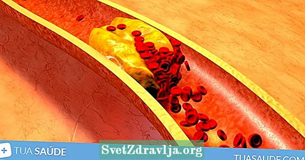 3 znaki, ki lahko kažejo na povišan holesterol