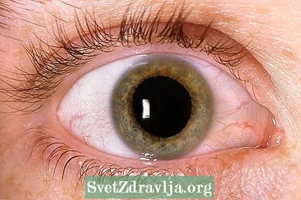 5 tes penting kanggo ngenali glaukoma