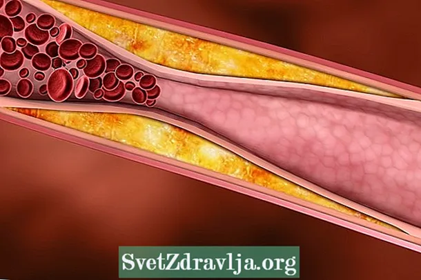 Top 5 príčin aterosklerózy - Vhodnosť
