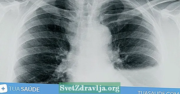 5 principais causas de auga no pulmón