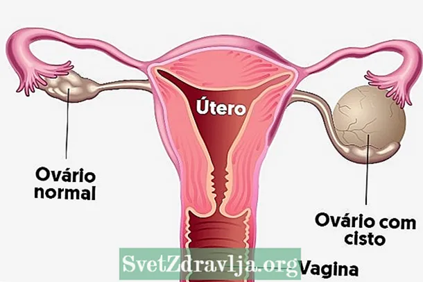 5 nga mga simtomas sa ovarian cyst nga dili nimo kinahanglan ibaliwala