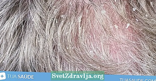 6 causas del dolor del cuero cabelludo y que hacer