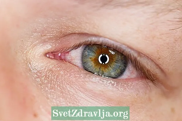 6 glavnih uzroka svrbeža u očima i šta učiniti - Zdravlje