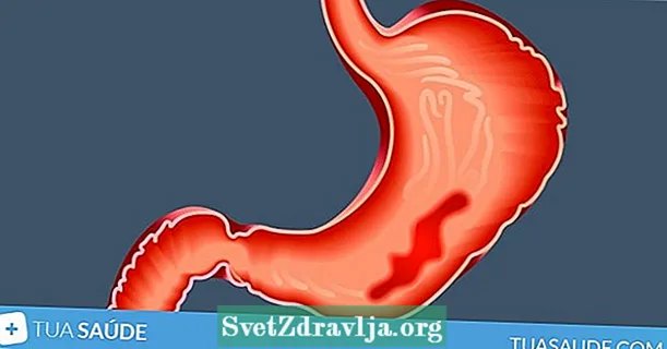 6 glavnih simptoma gastritisa