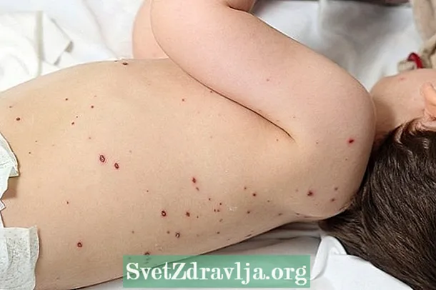7 preguntas comúns sobre a varicela