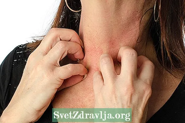 Dermatitis atopikoaren 7 sintoma nagusiak