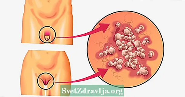 7 Hauptsymptome von Herpes genitalis