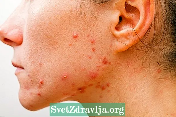 7 tippi principali di acne è cosa fà