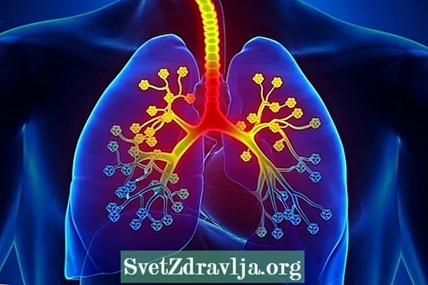 7 gejala yang mungkin mengindikasikan bronkitis
