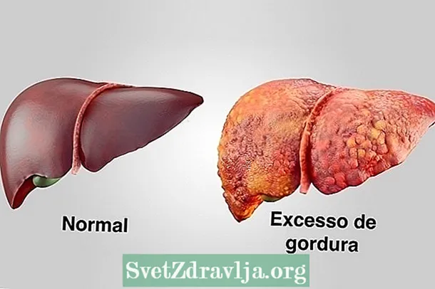 8 principais síntomas do fígado graxo