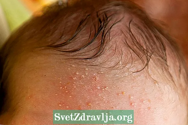 I-neonatal acne: yintoni kunye nendlela yokunyanga amaqhakuva elusaneni - Zempilo