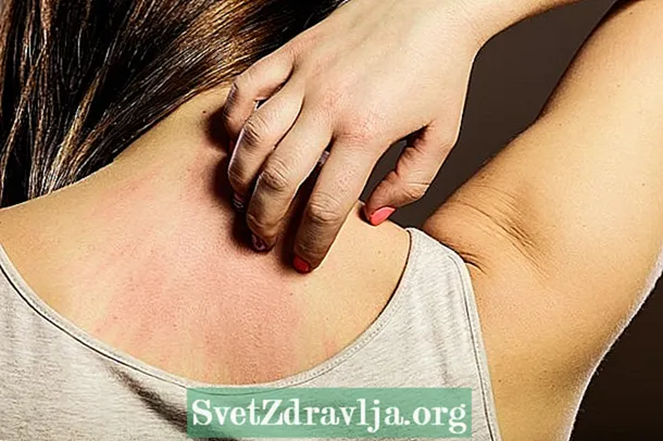Boya alerjisi: ana semptomlar ve ne yapmalı