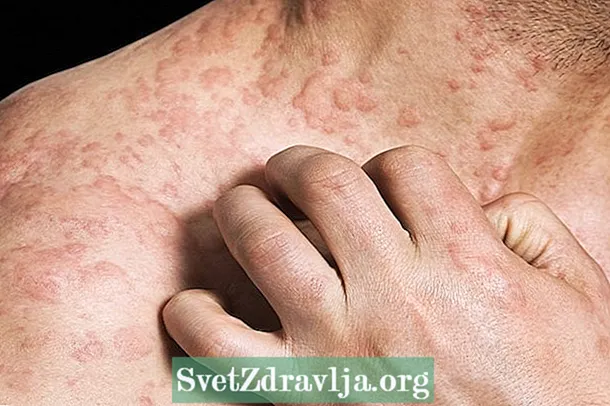 Koue allergie: wat dit is, simptome en behandeling