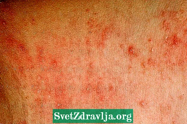 सनस्क्रीन gyलर्जी: लक्षणे आणि काय करावे - फिटनेस