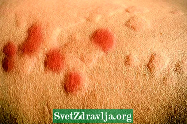 Алергія на ваду: асноўныя сімптомы і спосабы лячэння