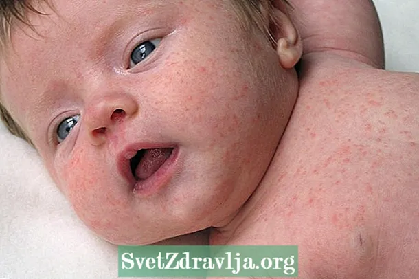 Babyallergie: hoofoorsake, simptome en wat om te doen