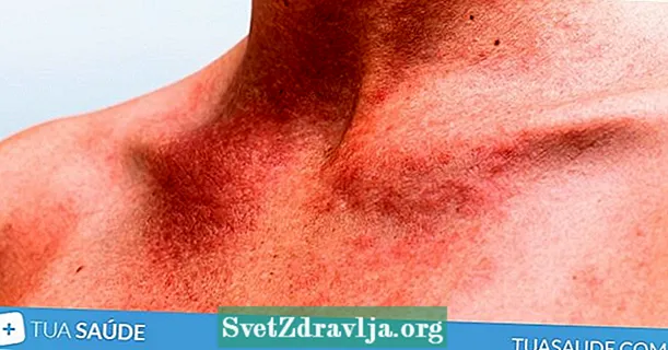 Skin allergy: isi na-akpata na otú e si na-emeso