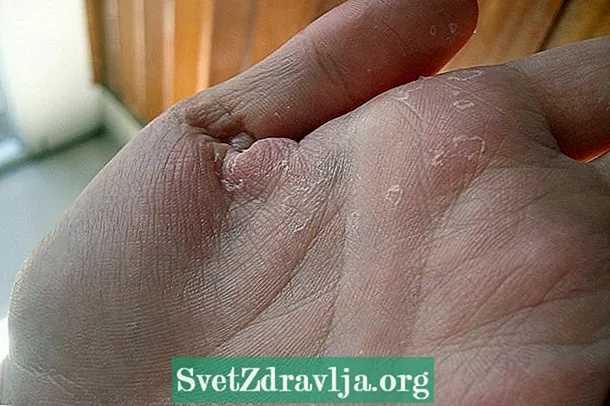 손의 알레르기 : 원인, 증상 및 치료