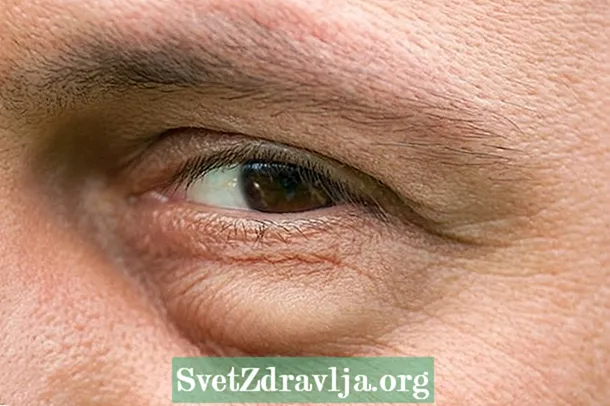 Alergi mata: penyebab utama, gejala dan apa yang harus dilakukan