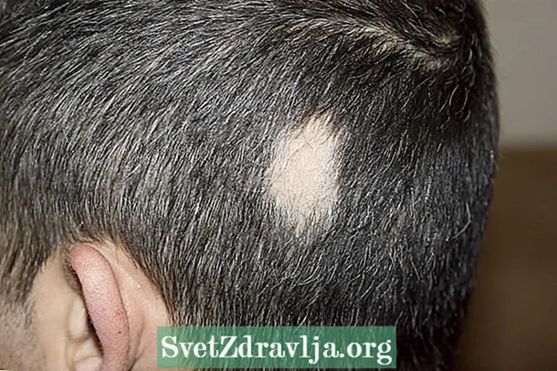 Alopecia areata: chì hè, cause possibili è cumu identificà - Salute
