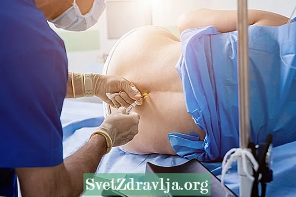 Epidurálna anestézia: čo to je, keď je indikované a možné riziká