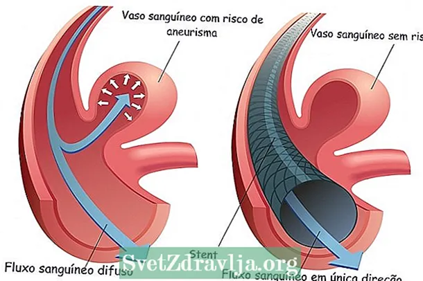 Cerebral aneurysm: ndi chiyani, zizindikiro, zoyambitsa ndi chithandizo