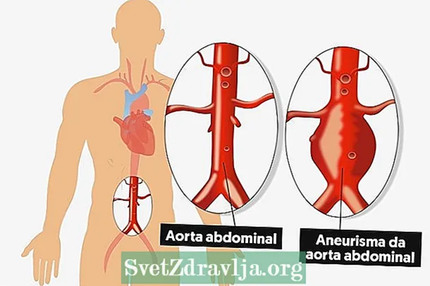 Aneurysm aortic: dè a th ’ann, comharraidhean, làimhseachadh agus lannsaireachd