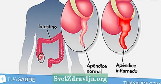 Appendicis: Quid est, Symptomata et Sanatio