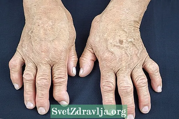 Cudurka 'Psoriatic arthritis': waa maxay, astaamaha iyo daaweynta