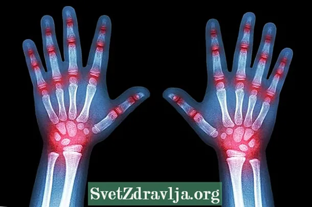 Artritis reaktif: apa, perawatan, gejala lan panyebabe