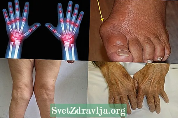 Rheumatoid Arthritis - Unsa ang mga Sintomas ug Giunsa Pagtambal