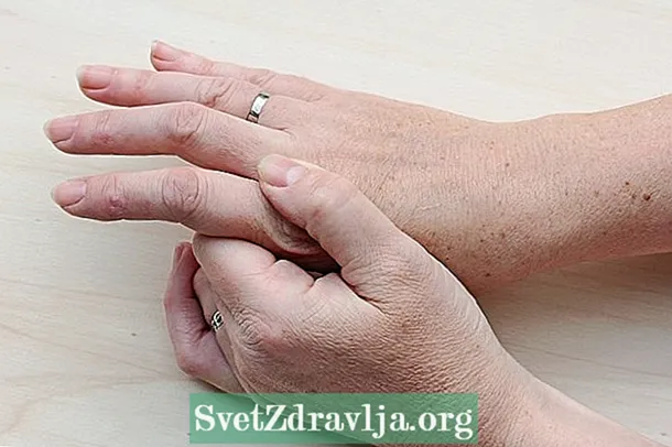 Artrosi in mani è dite: sintomi, cause è trattamentu